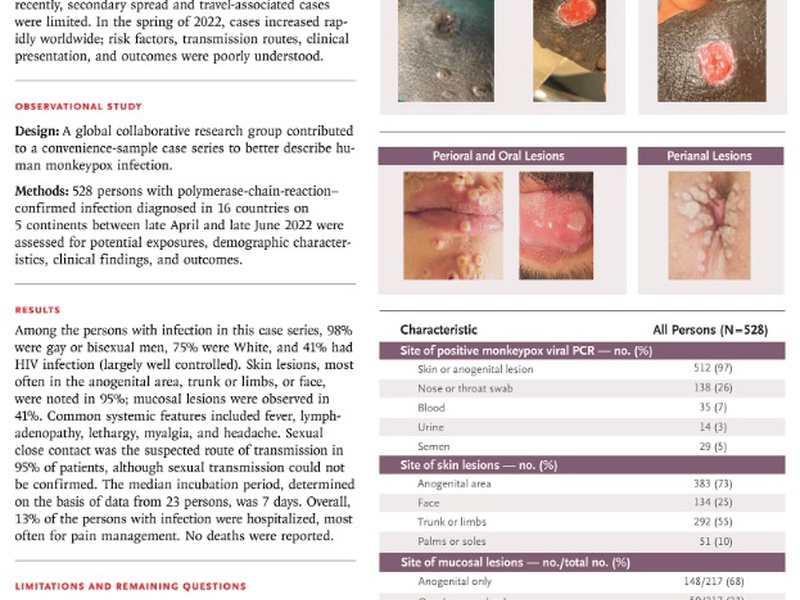 Monkeypox Virus Infection in Humans across 16 Countries — April–June 2022