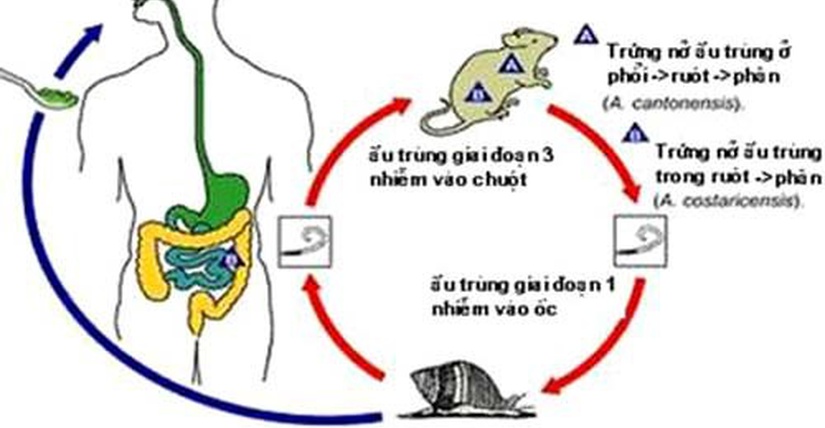 VIÊM MÀNG NÃO TĂNG BẠCH CẦU ÁI TOAN PHÁT HIỆN  TRỰC TIẾP Angiostrongylus cantonensis TRONG DỊCH NÃO TỦY:  BÁO CÁO TRƯỜNG HỢP