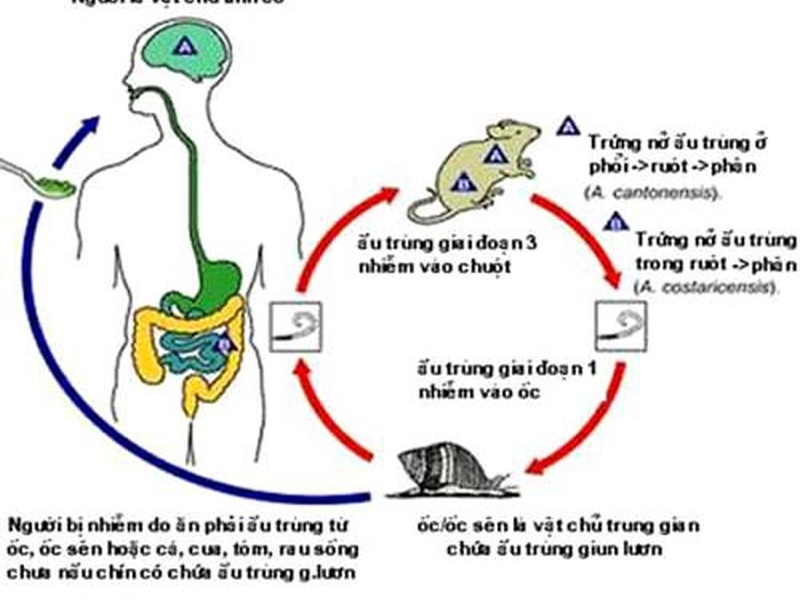 VIÊM MÀNG NÃO TĂNG BẠCH CẦU ÁI TOAN PHÁT HIỆN  TRỰC TIẾP Angiostrongylus cantonensis TRONG DỊCH NÃO TỦY:  BÁO CÁO TRƯỜNG HỢP